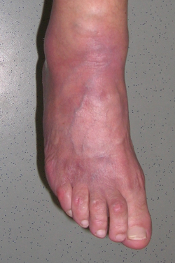 © Mateusz Markowicz Acrodermatitis chronica atrophicans bei einer 70jährigen Patientin