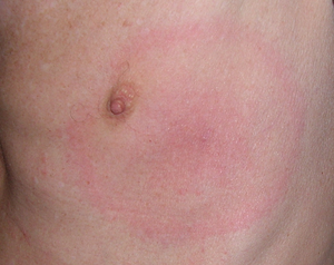Erythema migrans auf der linken Brust (Vergrößert das Bild in einem Dialog Fenster)